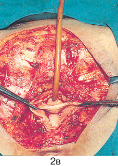 Простая вульвэктомия 3