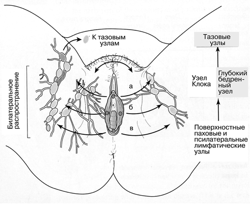 Основные направления метастазирования лимфы